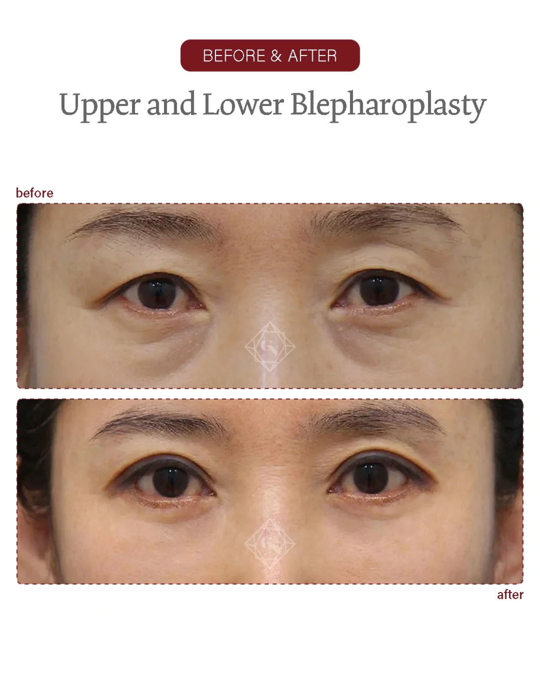 Lower blepharoplasty result at Garnet Plastic Surgery, Apgujeong