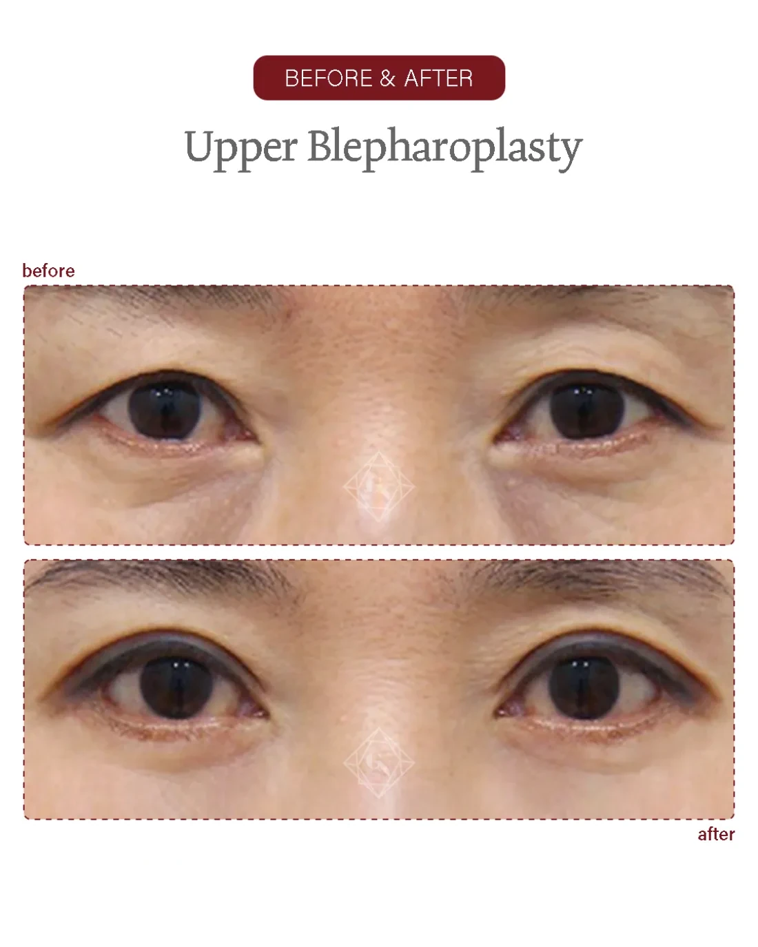 Lower blepharoplasty result at Garnet Plastic Surgery, Apgujeong