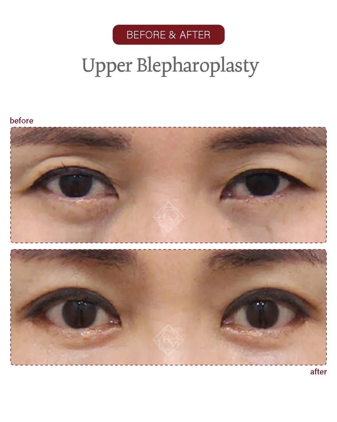Lower blepharoplasty result at Garnet Plastic Surgery, Apgujeong