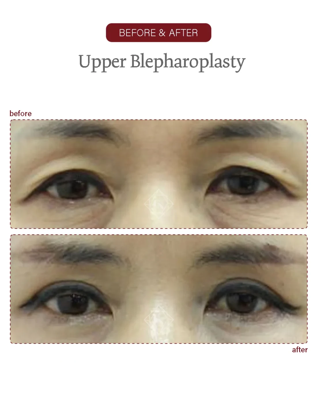 Lower blepharoplasty result at Garnet Plastic Surgery, Apgujeong