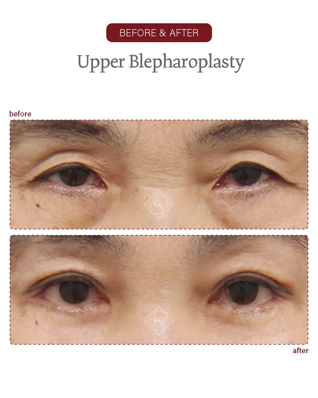 Lower blepharoplasty result at Garnet Plastic Surgery, Apgujeong