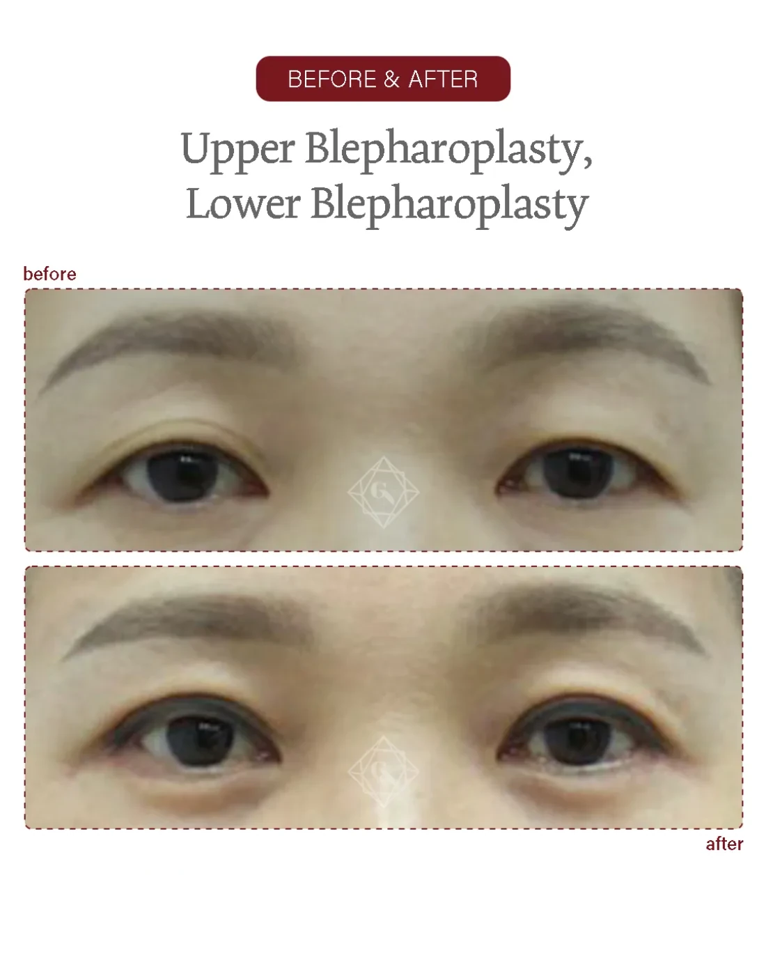 Upper blepharoplasty result at Garnet Plastic Surgery, Apgujeong