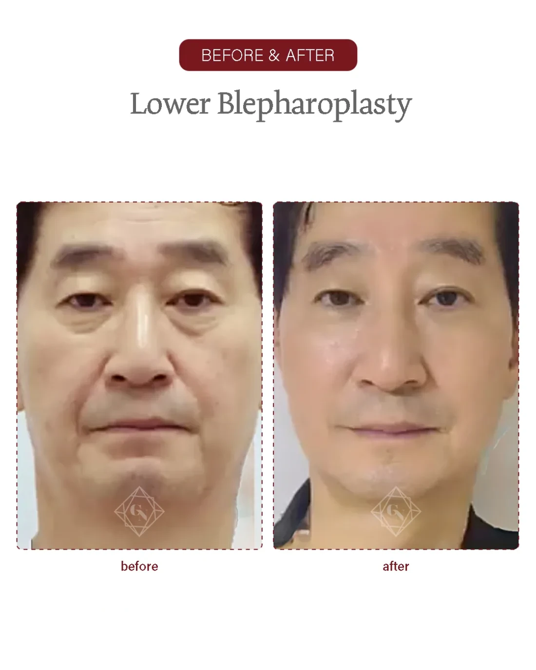 Upper blepharoplasty result at Garnet Plastic Surgery, Apgujeong