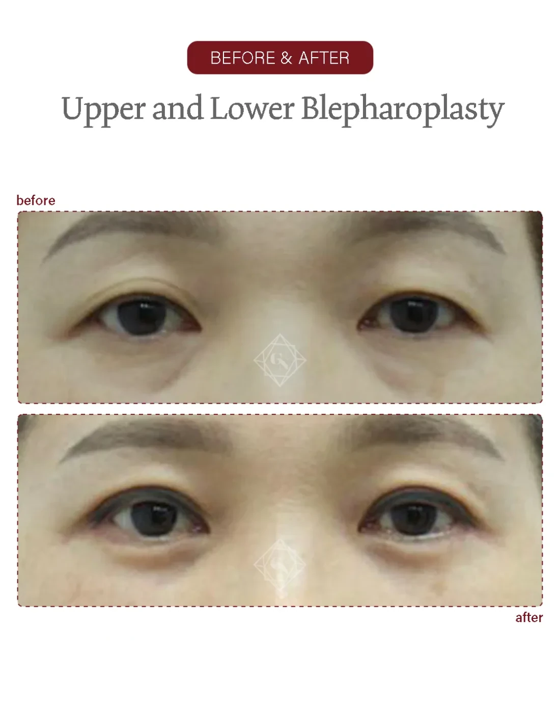 Upper blepharoplasty result at Garnet Plastic Surgery, Apgujeong
