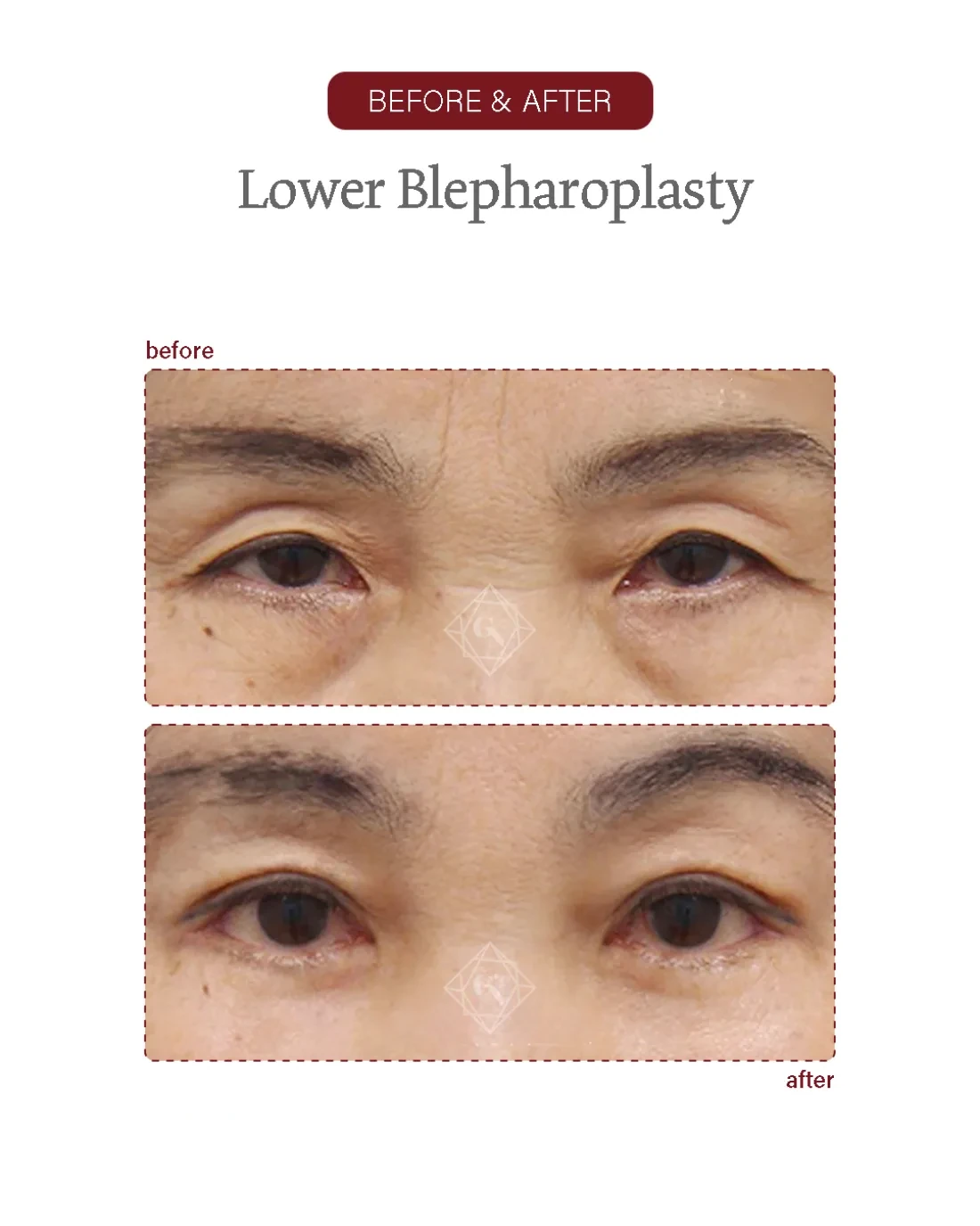 Upper blepharoplasty result at Garnet Plastic Surgery, Apgujeong