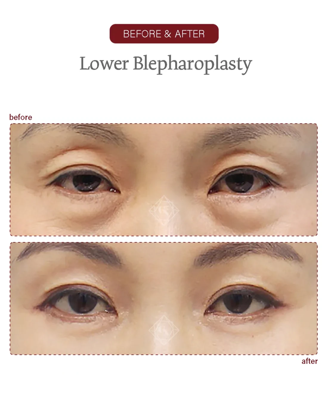Before and after Upper & Lower Blepharoplasty at Garnet Plastic Surgery, Apgujeong Seoul — actual patient