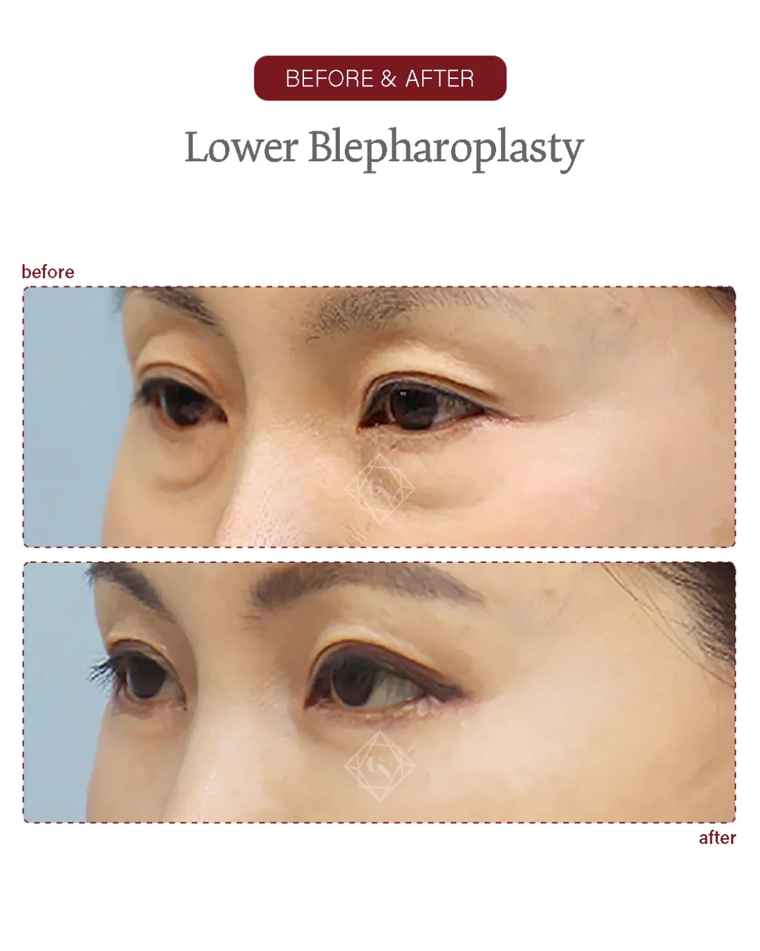 Before and after Upper & Lower Blepharoplasty at Garnet Plastic Surgery, Apgujeong Seoul — actual patient