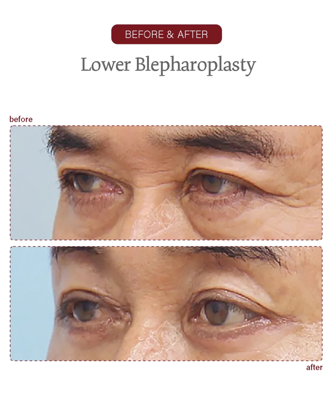Before and after Upper & Lower Blepharoplasty at Garnet Plastic Surgery, Apgujeong Seoul — actual patient