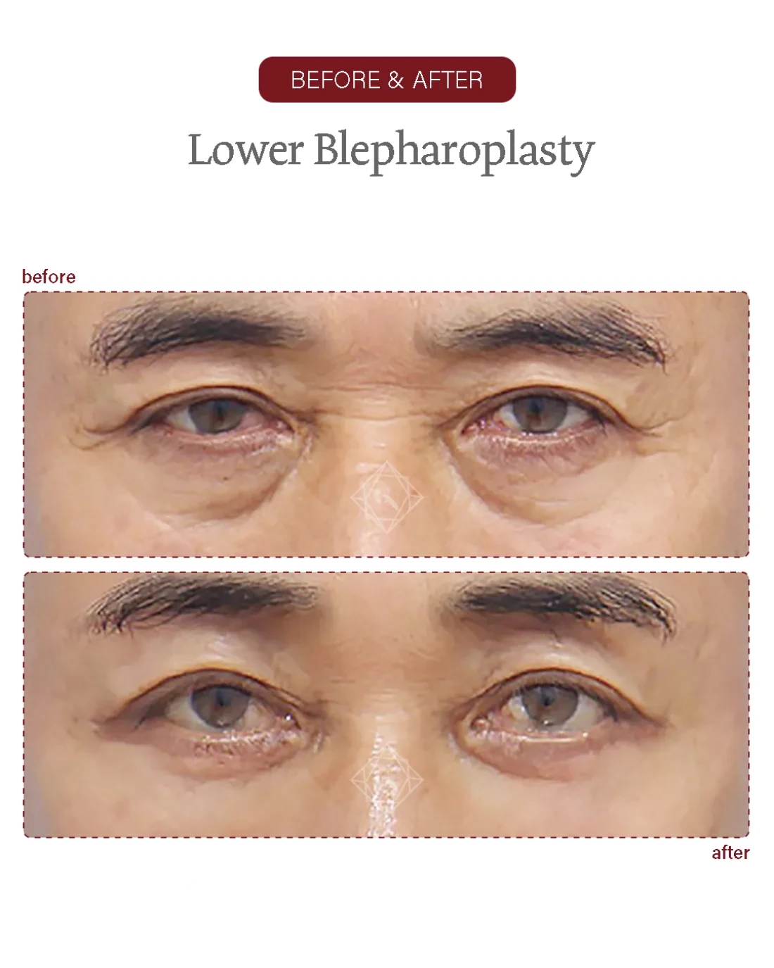 Before and after Upper & Lower Blepharoplasty at Garnet Plastic Surgery, Apgujeong Seoul — actual patient