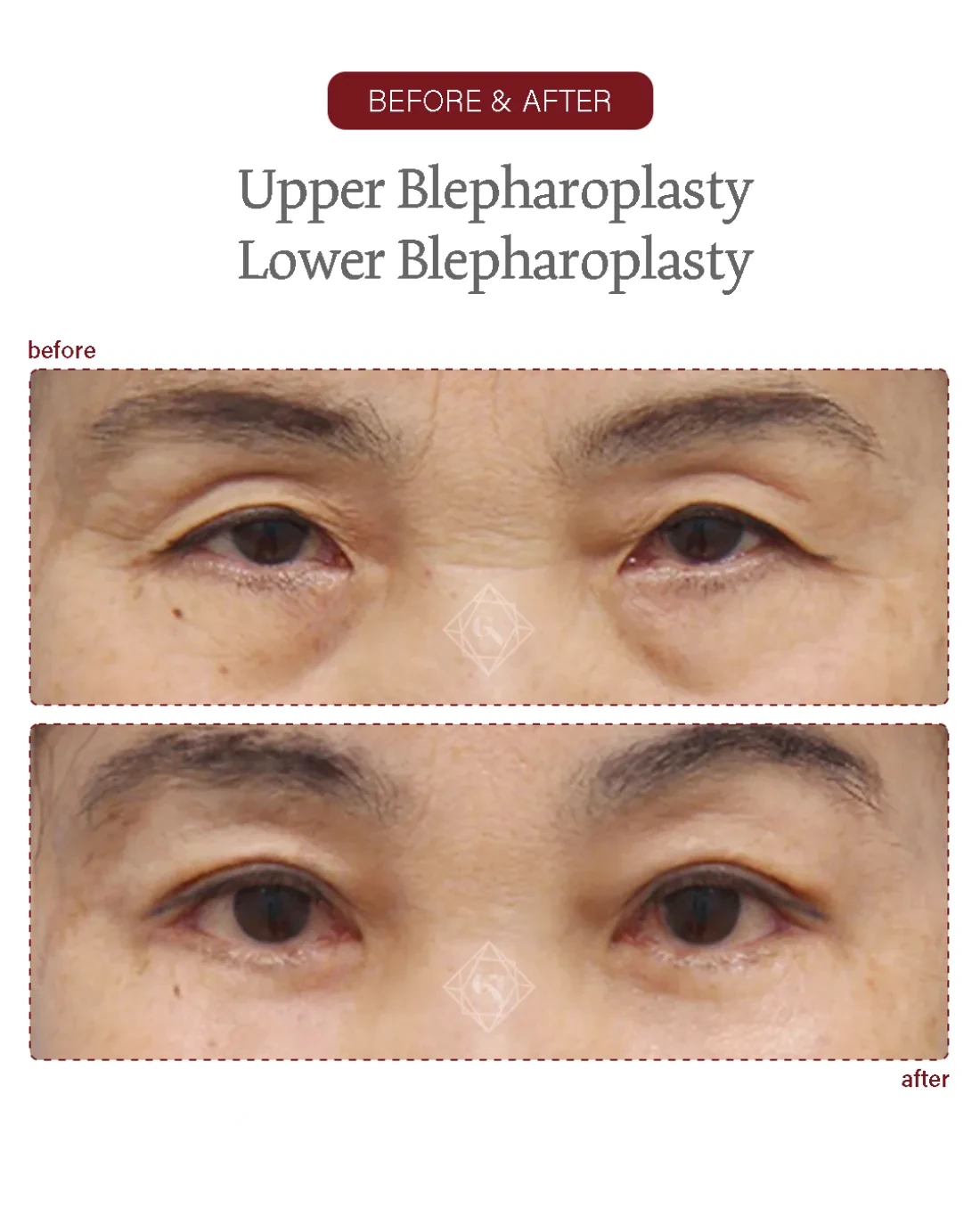 Before and after Upper & Lower Blepharoplasty at Garnet Plastic Surgery, Apgujeong Seoul — actual patient