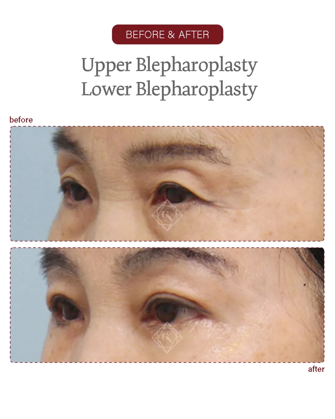 Before and after Upper & Lower Blepharoplasty at Garnet Plastic Surgery, Apgujeong Seoul — actual patient