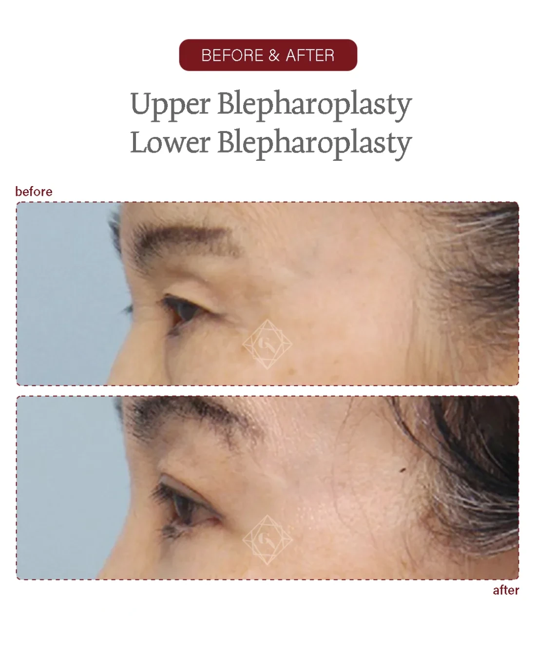 Before and after Upper & Lower Blepharoplasty at Garnet Plastic Surgery, Apgujeong Seoul — actual patient