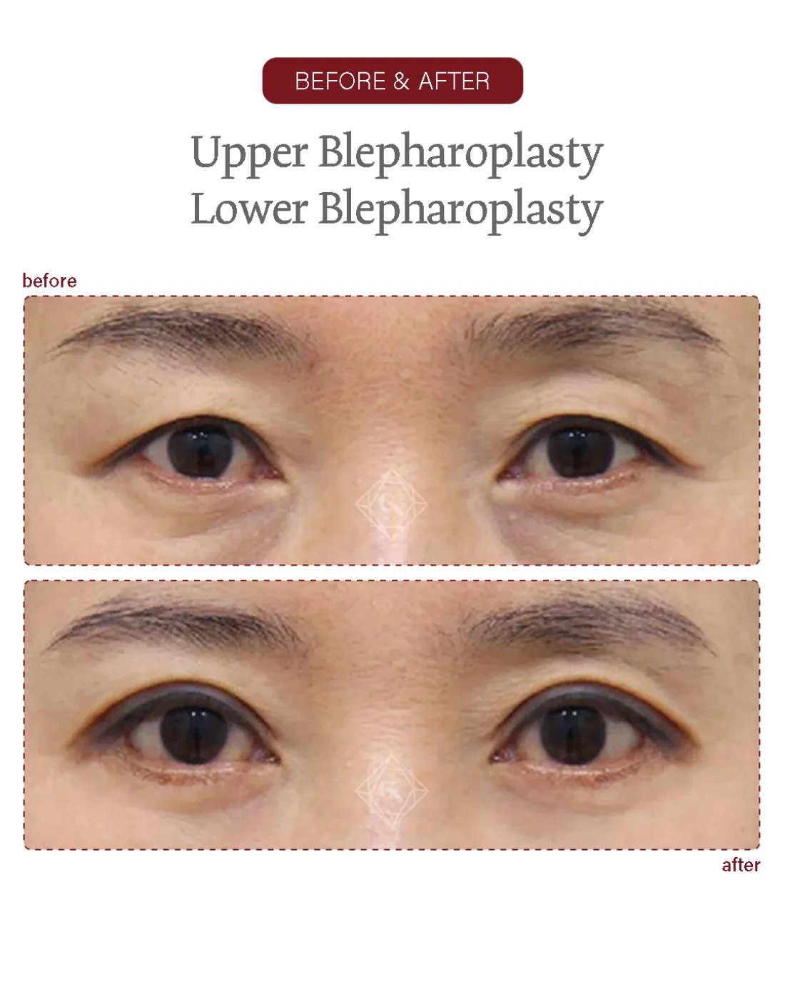 Before and after Upper & Lower Blepharoplasty at Garnet Plastic Surgery, Apgujeong Seoul — actual patient