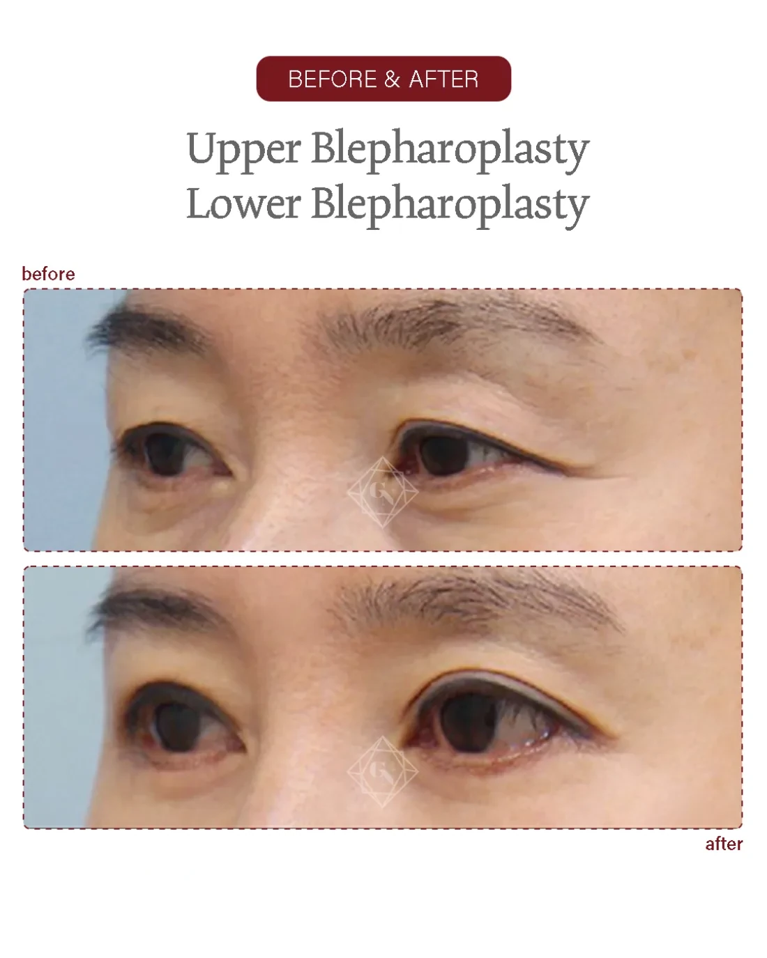 Before and after Upper & Lower Blepharoplasty at Garnet Plastic Surgery, Apgujeong Seoul — actual patient