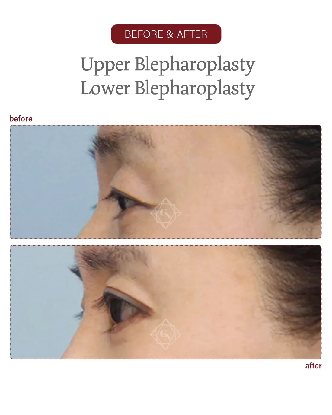 Before and after Upper & Lower Blepharoplasty at Garnet Plastic Surgery, Apgujeong Seoul — actual patient