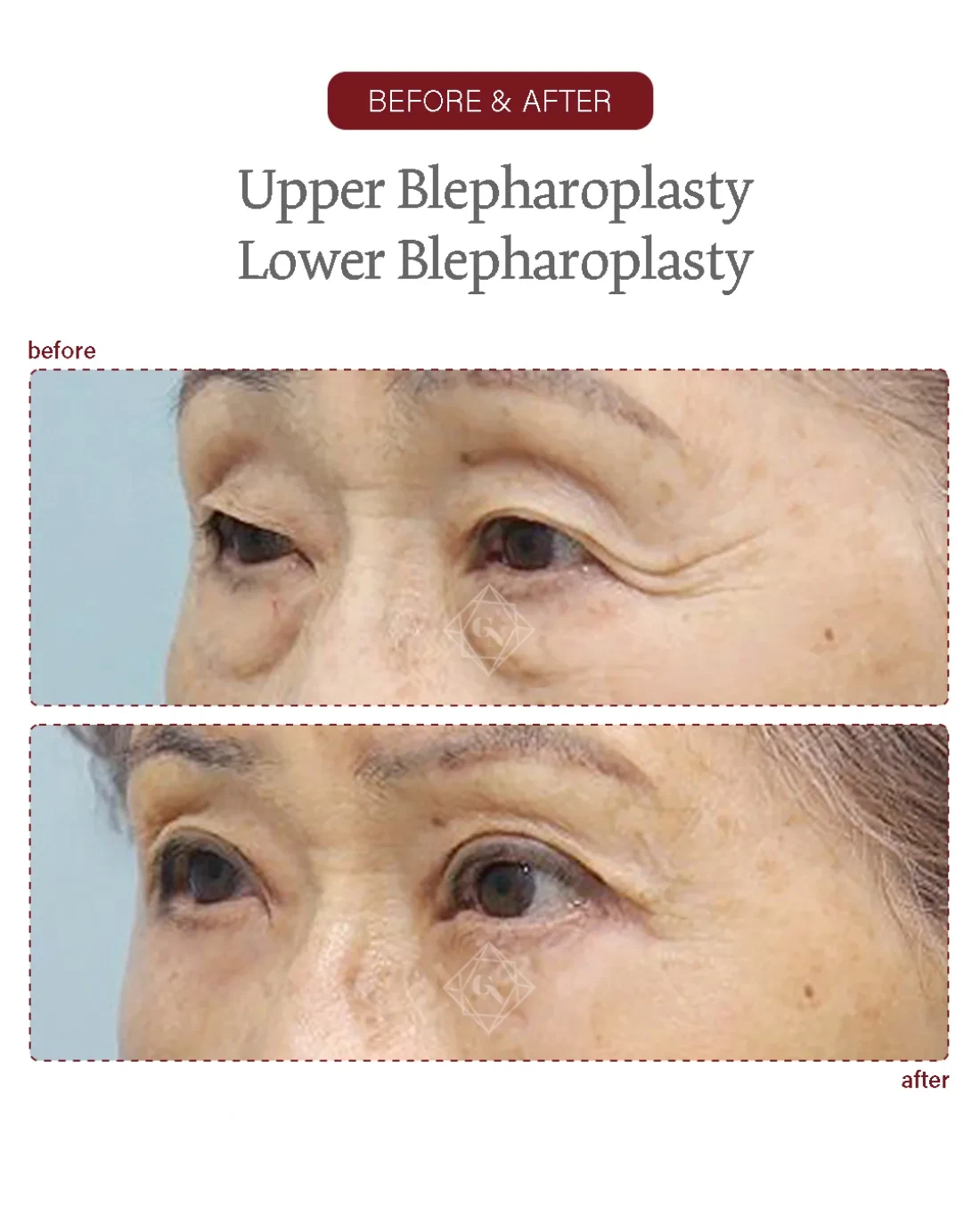 Before and after Upper & Lower Blepharoplasty at Garnet Plastic Surgery, Apgujeong Seoul — actual patient