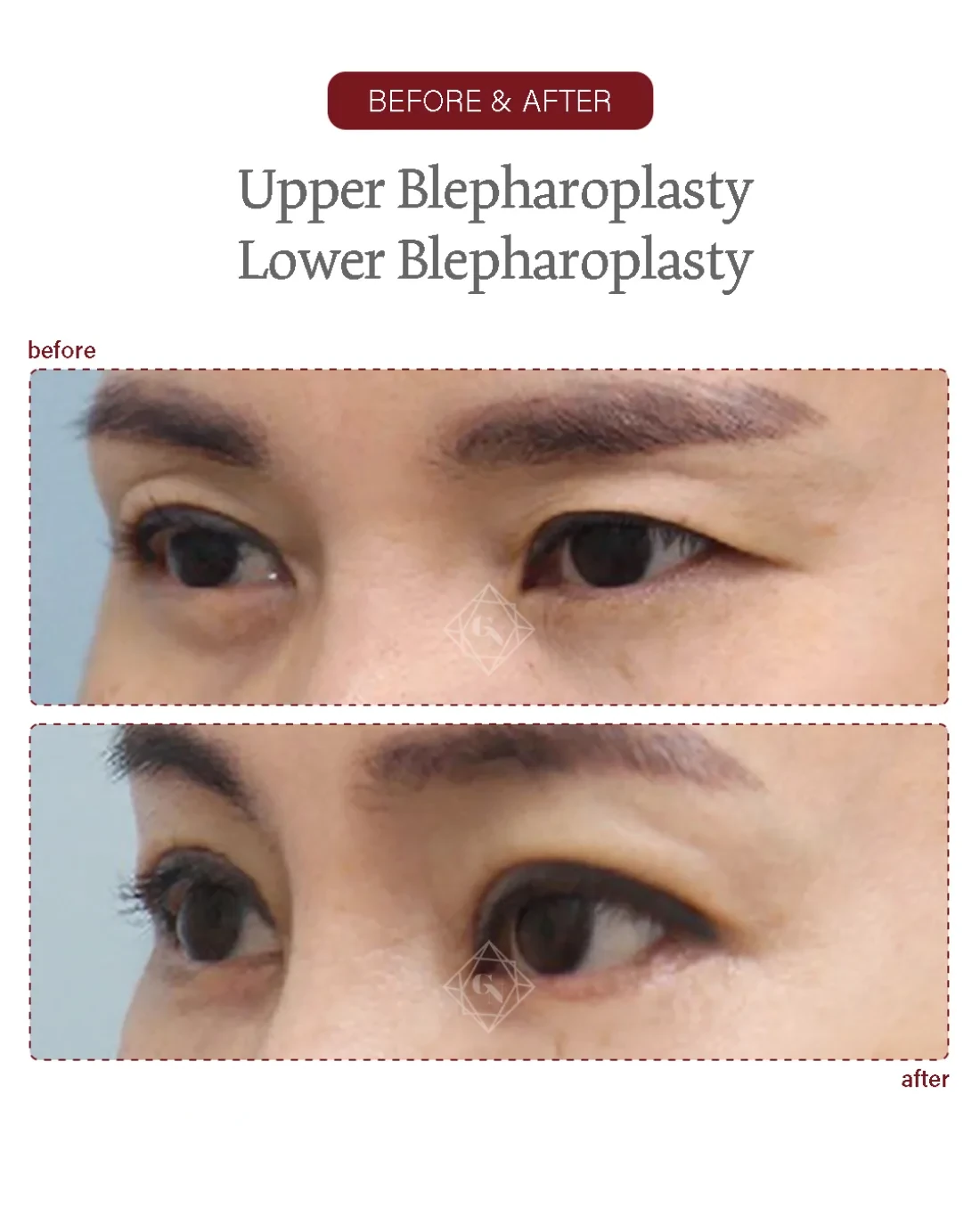 Before and after Upper & Lower Blepharoplasty at Garnet Plastic Surgery, Apgujeong Seoul — actual patient