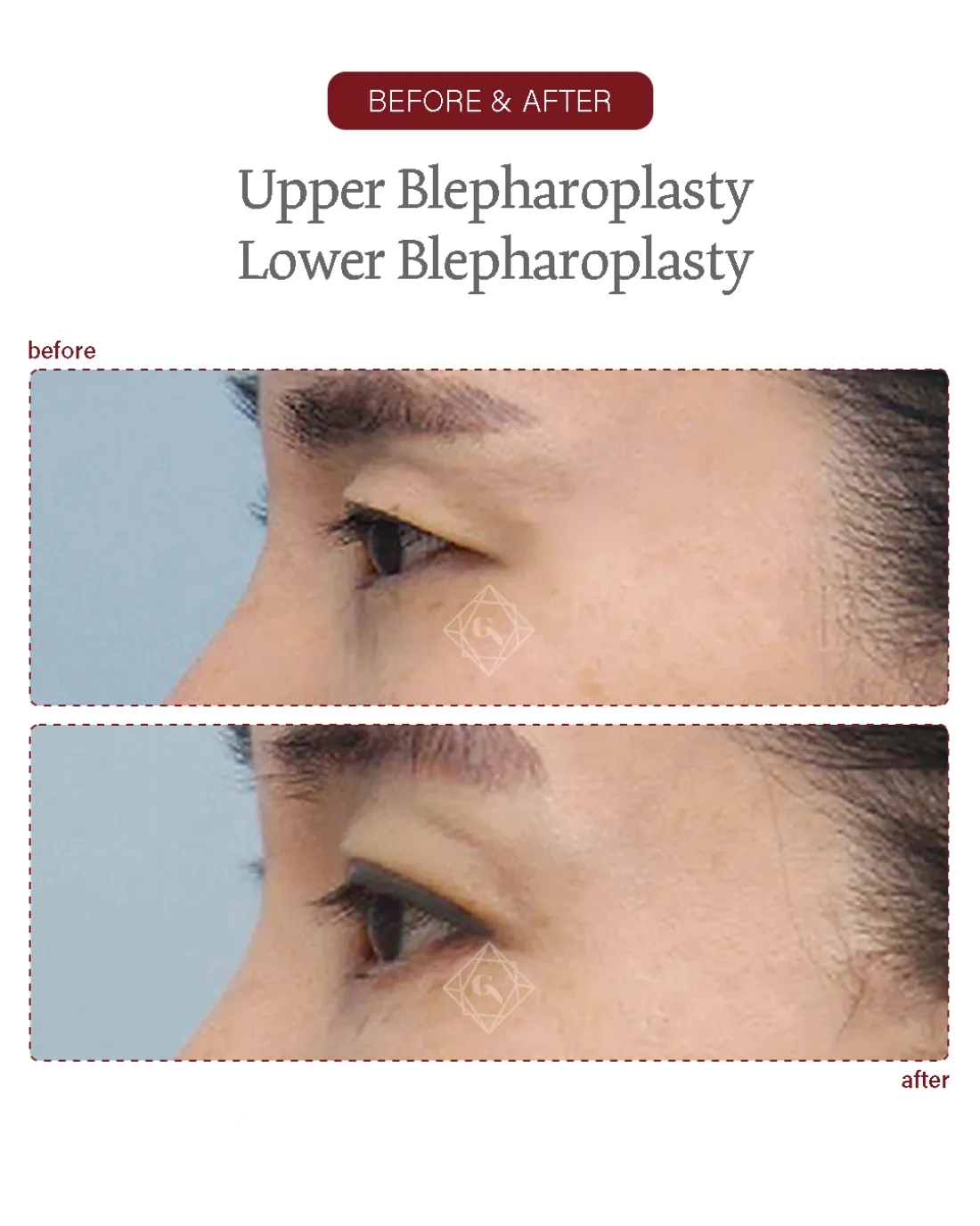 Before and after Upper & Lower Blepharoplasty at Garnet Plastic Surgery, Apgujeong Seoul — actual patient