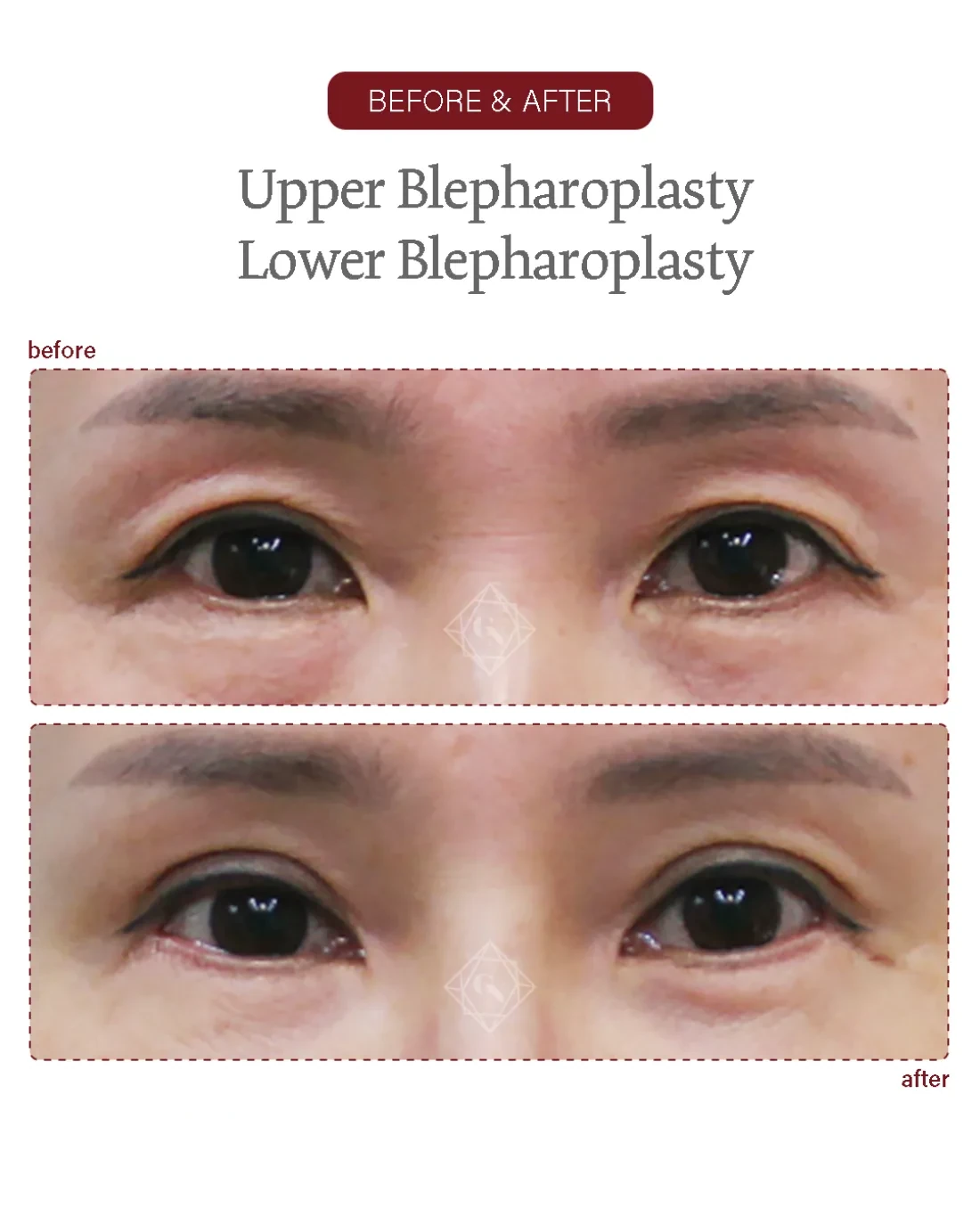 Before and after Upper & Lower Blepharoplasty at Garnet Plastic Surgery, Apgujeong Seoul — actual patient