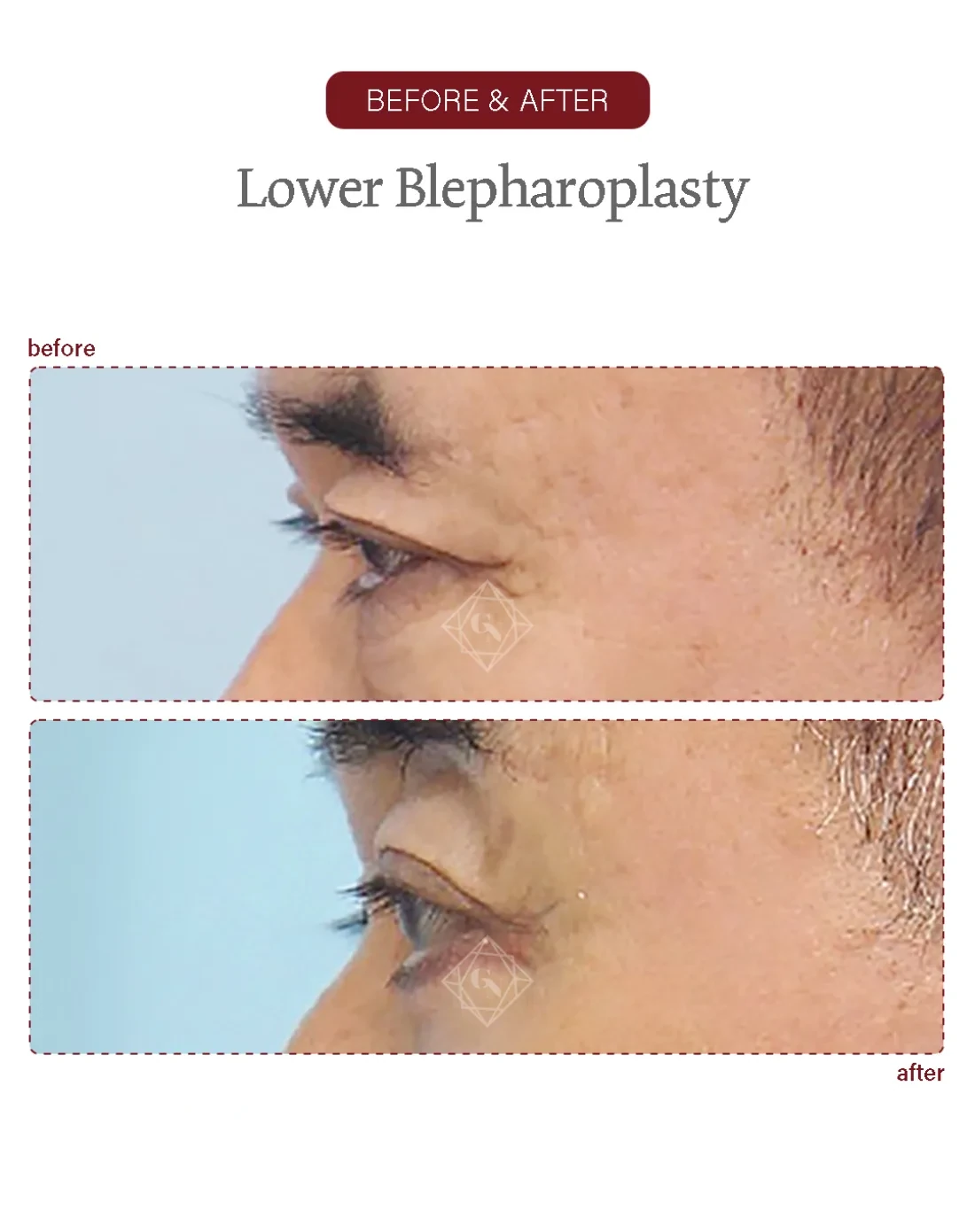 Before and after Upper & Lower Blepharoplasty at Garnet Plastic Surgery, Apgujeong Seoul — actual patient