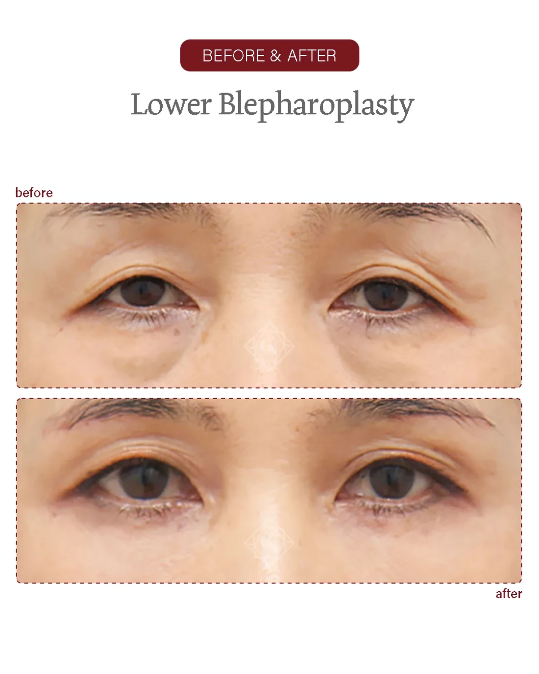 Before and after Upper & Lower Blepharoplasty at Garnet Plastic Surgery, Apgujeong Seoul — actual patient