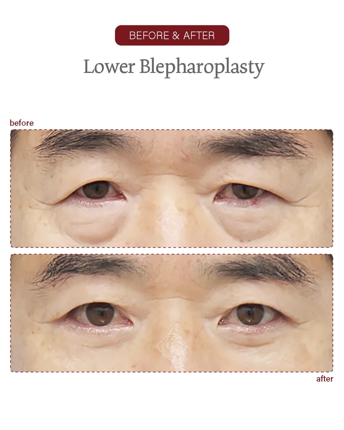 Before and after Upper & Lower Blepharoplasty at Garnet Plastic Surgery, Apgujeong Seoul — actual patient