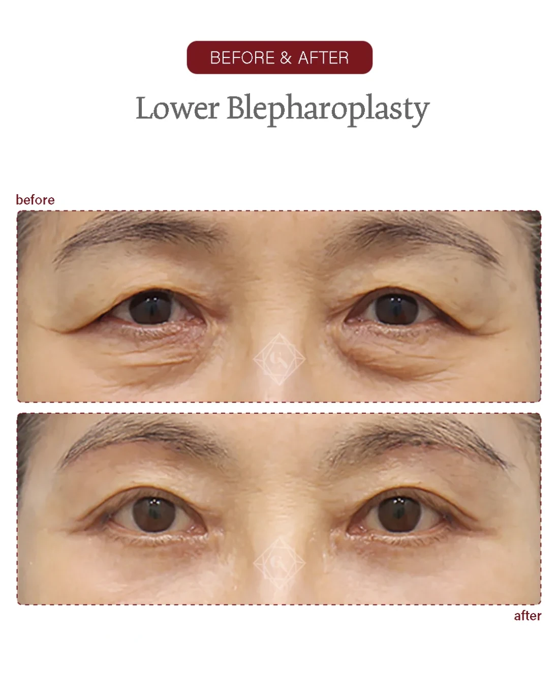 Before and after Upper & Lower Blepharoplasty at Garnet Plastic Surgery, Apgujeong Seoul — actual patient
