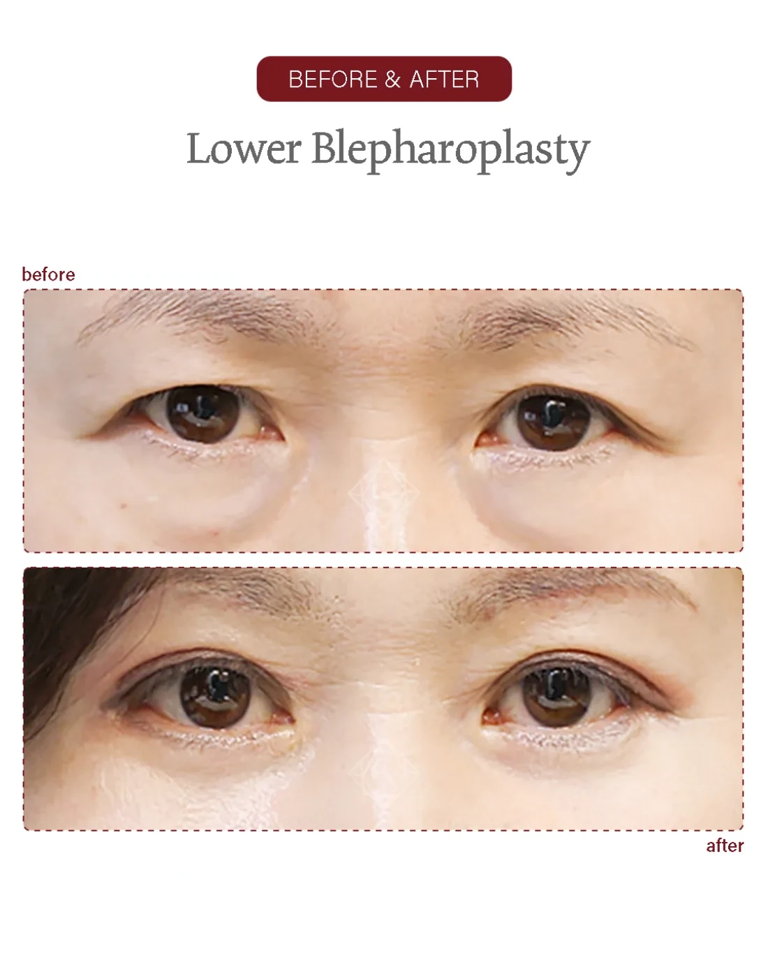 Before and after Upper & Lower Blepharoplasty at Garnet Plastic Surgery, Apgujeong Seoul — actual patient