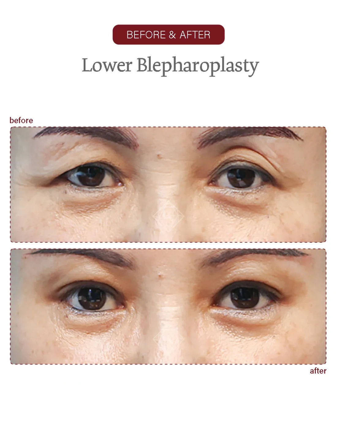 Before and after Upper & Lower Blepharoplasty at Garnet Plastic Surgery, Apgujeong Seoul — actual patient