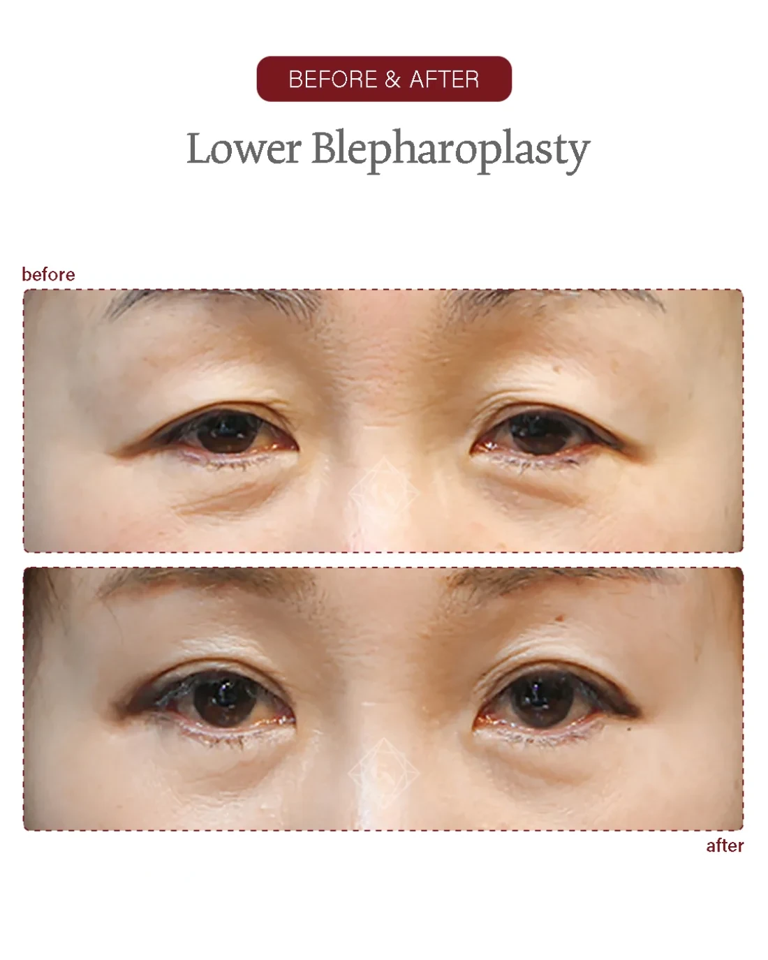 Before and after Upper & Lower Blepharoplasty at Garnet Plastic Surgery, Apgujeong Seoul — actual patient