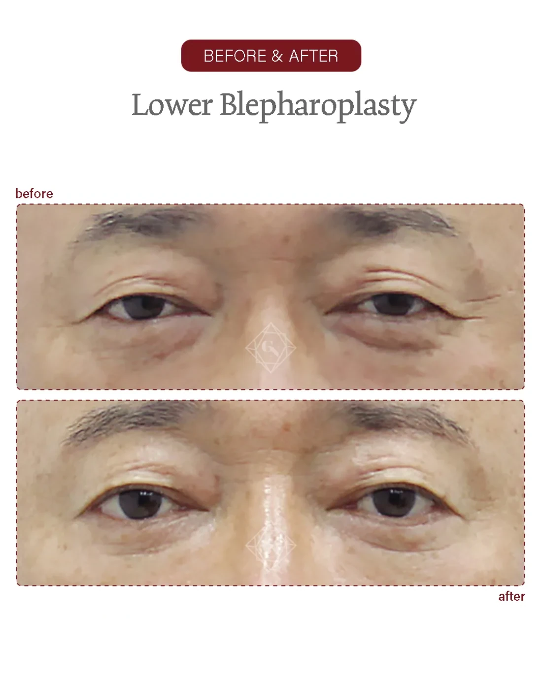 Before and after Upper & Lower Blepharoplasty at Garnet Plastic Surgery, Apgujeong Seoul — actual patient